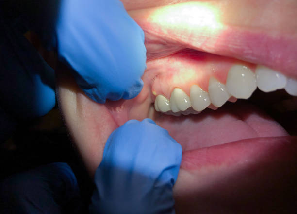 Best Emergency Treatment for Dental Infections or Abscesses in Viera East, FL